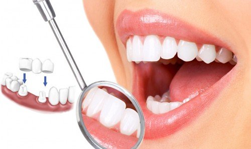 Bọc răng sứ thẩm mỹ ngày càng được ưa chuộng.