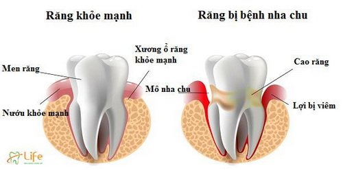 Bệnh nha chu viêm nếu không điều trị kịp thời sẽ dẫn đến mất răng do xương và các mô liên kết quanh chân răng bị phá hủy.