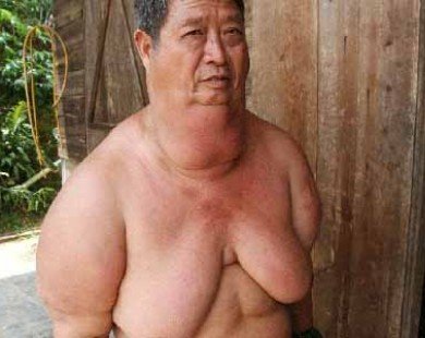 Người đàn ông khốn khổ vì ngực ’khủng’ ở Lâm Đồng