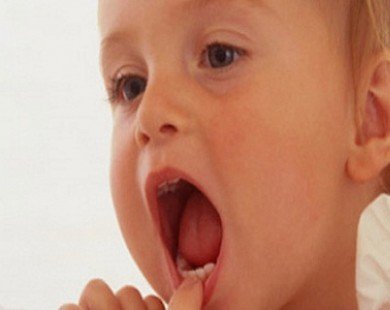 Viêm nướu răng ở trẻ