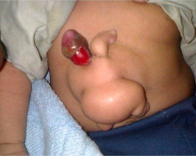 Bào thai dị dạng sống ký sinh trong cơ thể bé trai