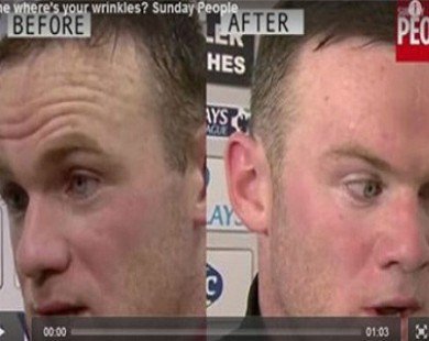 Rooney tiêm botox xóa nếp nhăn?