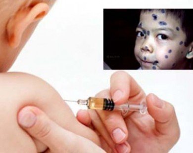 Vắc-xin thủy đậu đã ’hạ cánh’ xuống Việt Nam