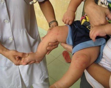 Ministry demands tighter prevention of hand-foot-mouth disease
