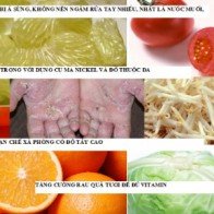 Bệnh á sừng: Làm gì để hạn chế khó chịu?