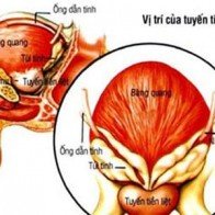 Đối tượng dễ mắc ung thư tiền liệt tuyến