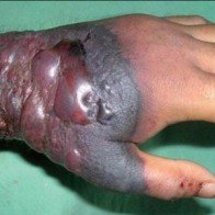 Những dấu hiệu nhận biết và triệu chứng của bệnh do virut Ebola