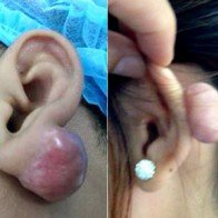 Cẩn trọng bấm lỗ tai tự hại mình