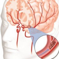 Xử trí đột quỵ não tại nhà