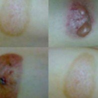 Xử trí khi bị bỏng bô xe máy