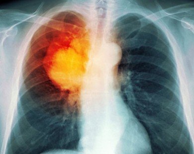 Có 5 triệu chứng sau coi chừng ung thư phổi