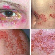 Báo động sốt mò - căn bệnh nguy hiểm đã quay trở lại