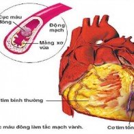 Cảnh giác đột quị não khi giao mùa