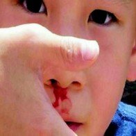 Chảy máu cam ở trẻ em: xử trí và phòng ngừa