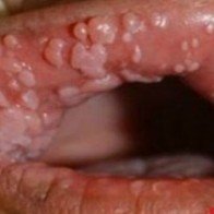 Sùi mào gà mọc chi chít quanh miệng, mùi như thịt thối