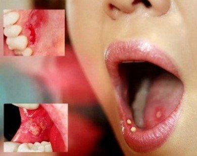 Biểu hiện không ngờ chứng tỏ bạn có nguy cơ bị ung thư miệng