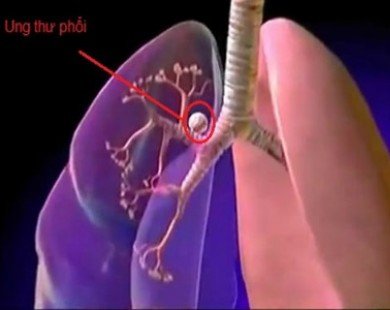 Hút thuốc lá có thể bị 8 bệnh ung thư