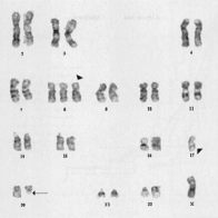 Rối loạn sinh tuỷ là bệnh gì?