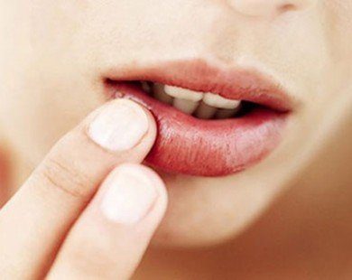 4 cách để môi không bị chảy máu trong mùa đông