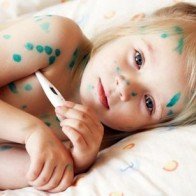 Cách phòng tránh bệnh thủy đậu