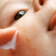 Mẹo chữa bé bị muỗi đốt hoặc côn trùng cắn