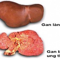 Tất cả những tác nhân có thể dẫn đến ung thư gan