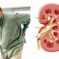 3 bài thuốc nam chữa sỏi thận vô cùng hiệu quả