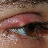 Mẹo hay chữa lẹo mắt “thần tốc” tại nhà không để lại sẹo