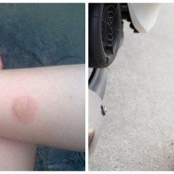 Chữa bỏng bô xe máy - bí kíp giắt lưng ai ai cũng cần có