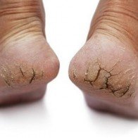 Trị nứt gót chân tại nhà đơn giản nhất