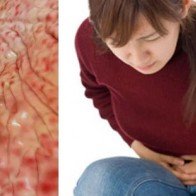 Bài thuốc chữa viêm loét dạ dày "thần thánh" chỉ 1 tuần là khỏi