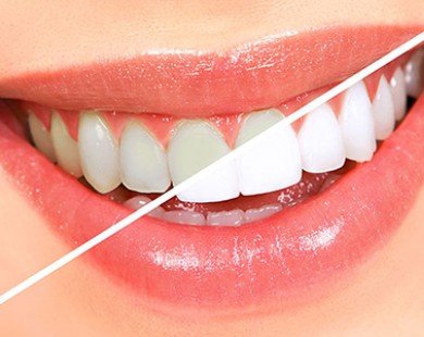 Lấy hết cao răng tại nhà mà không gây đau đớn