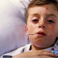 Tìm hiểu một số bệnh da liễu thường gặp