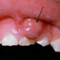 Cách phòng tránh ung thư miệng - điều ai cũng cần