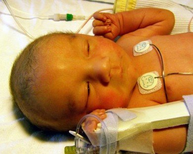 Tất tần tật về vàng da ở trẻ sơ sinh