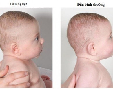 Nguyên nhân và cách khắc phục chứng móp đầu ở trẻ