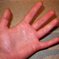 2 cách dân gian đơn giản chữa ra mồ hôi tay