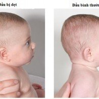 Nguyên nhân và cách khắc phục chứng móp đầu ở trẻ