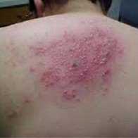 Hết hẳn 'giời leo' chỉ sau 3 ngày, nhờ bài thuốc dân gian hoàn toàn không để lại sẹo