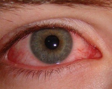 Biến chứng nặng nề khi tự ý chữa đau mắt đỏ
