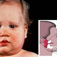 Dấu hiệu nhận biết sớm bệnh quai bị