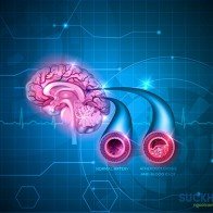 Các giai đoạn phát triển bệnh xơ vữa động mạch