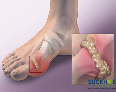 Nguyên nhân nào gây nên bệnh Gout?