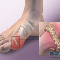 Nguyên nhân nào gây nên bệnh Gout?