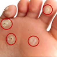 Bệnh mắt cá chân và cách chữa trị tại nhà hiệu quả!