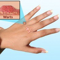 Cách chữa mụn cóc ở chân – tay hiệu quả