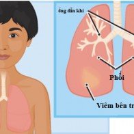 Ngăn chặn viêm phổi ở trẻ