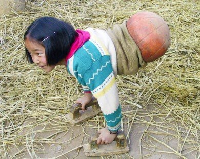 Cuộc đời kỳ diệu của 'cô gái bóng rổ' mất chân sau tai nạn