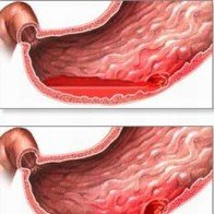 Viêm dạ dày mạn và thuốc chữa