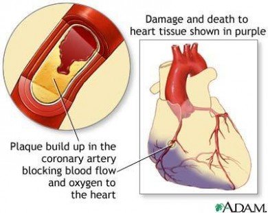 Người thiếu máu cơ tim cục bộ nên ăn uống như thế nào?